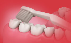 반여동치과 증례 케이스