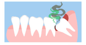 반여동치과 증례 케이스