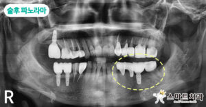 반여동임플란트치과 스마트치과