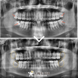 반여동치과 증례 케이스