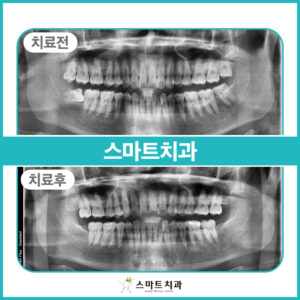반여동치과 증례 케이스