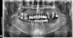 반여동임플란트