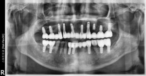 반여동임플란트