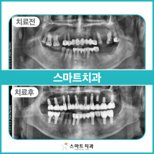 반여동임플란트