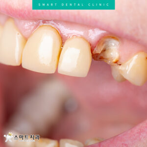 반여동충치치과 스마트치과