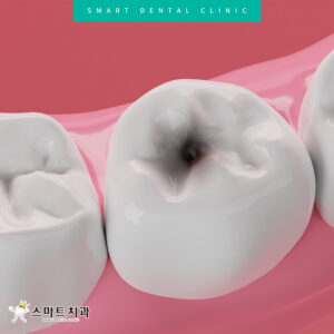 반여동충치치과 스마트치과