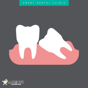 재송동추천치과 스마트치과