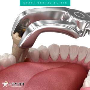 반여동충치치과 스마트치과