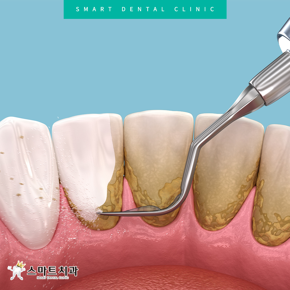 반여동스케일링치과