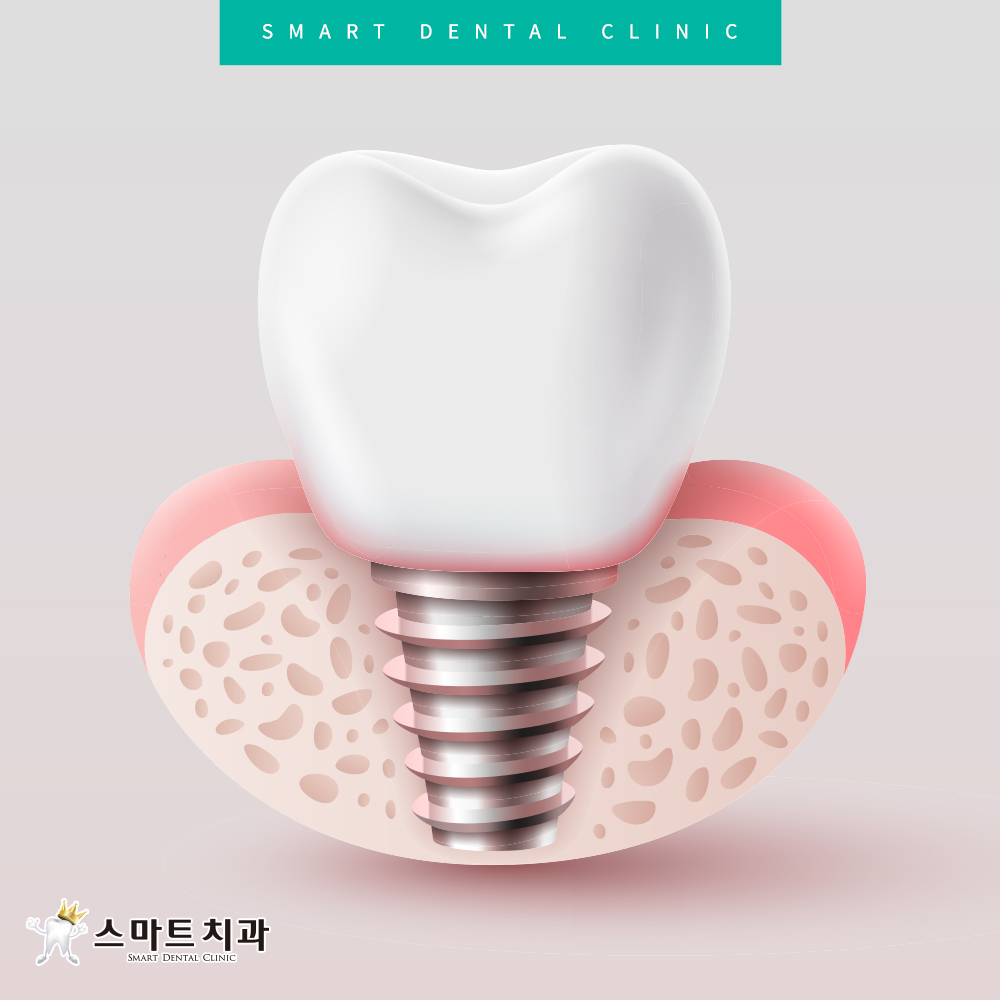 안락동임플란트치과