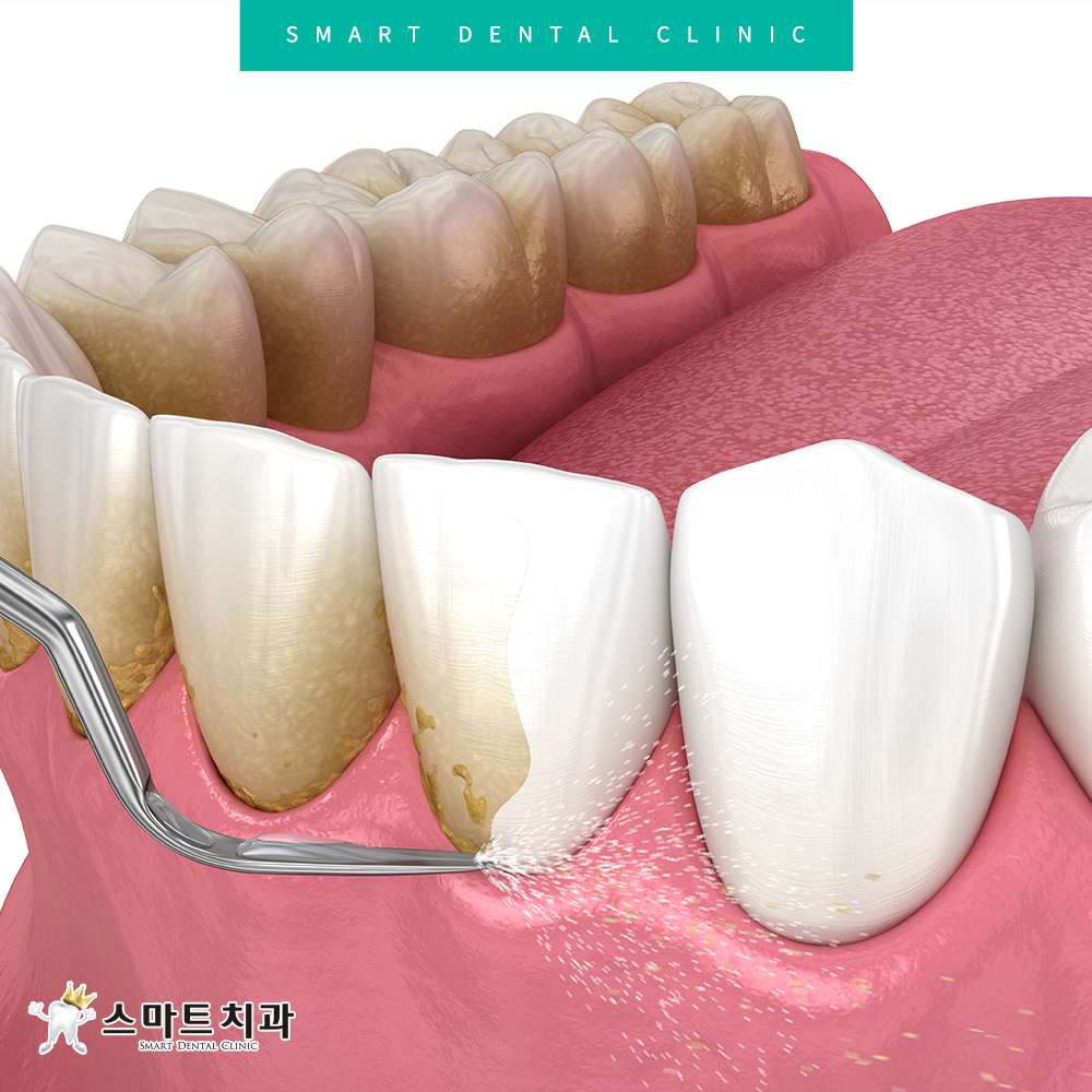 반여동스케일링치과
