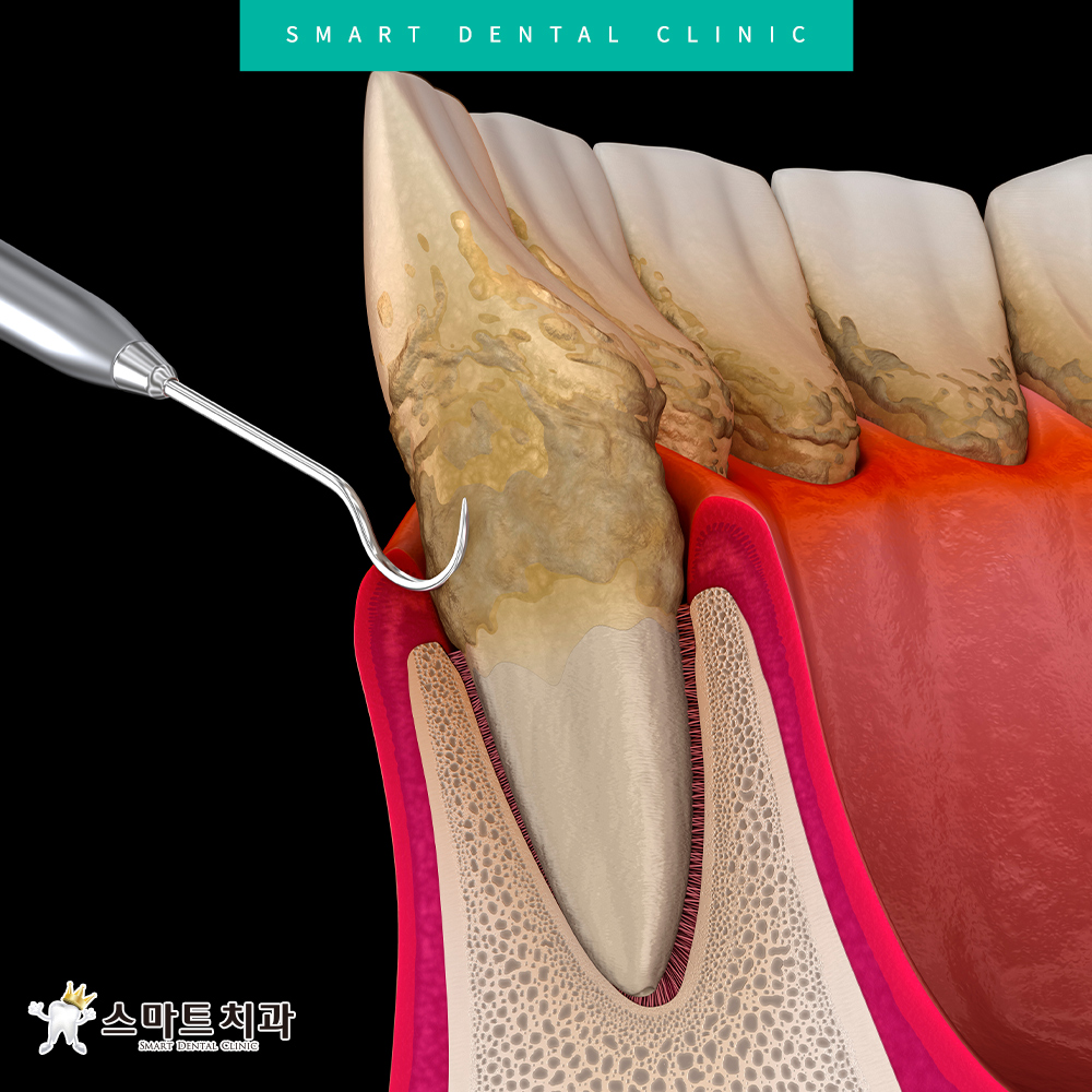 반여동스케일링치과