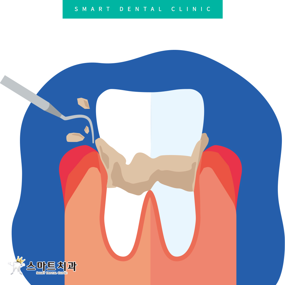 반여동스케일링치과