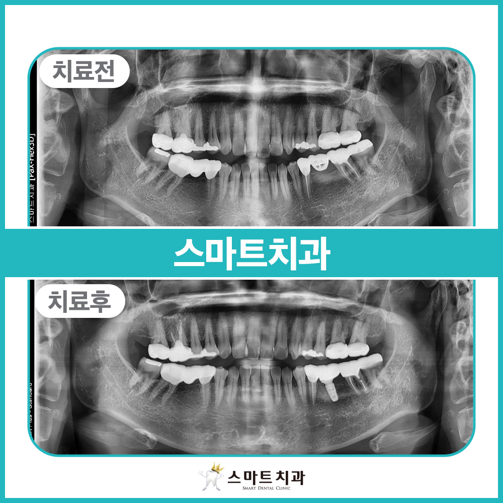 안락동임플란트치과