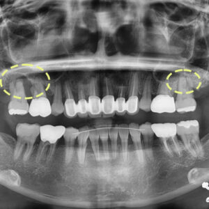 안락동임플란트