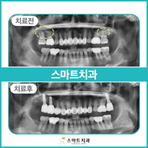 안락동임플란트