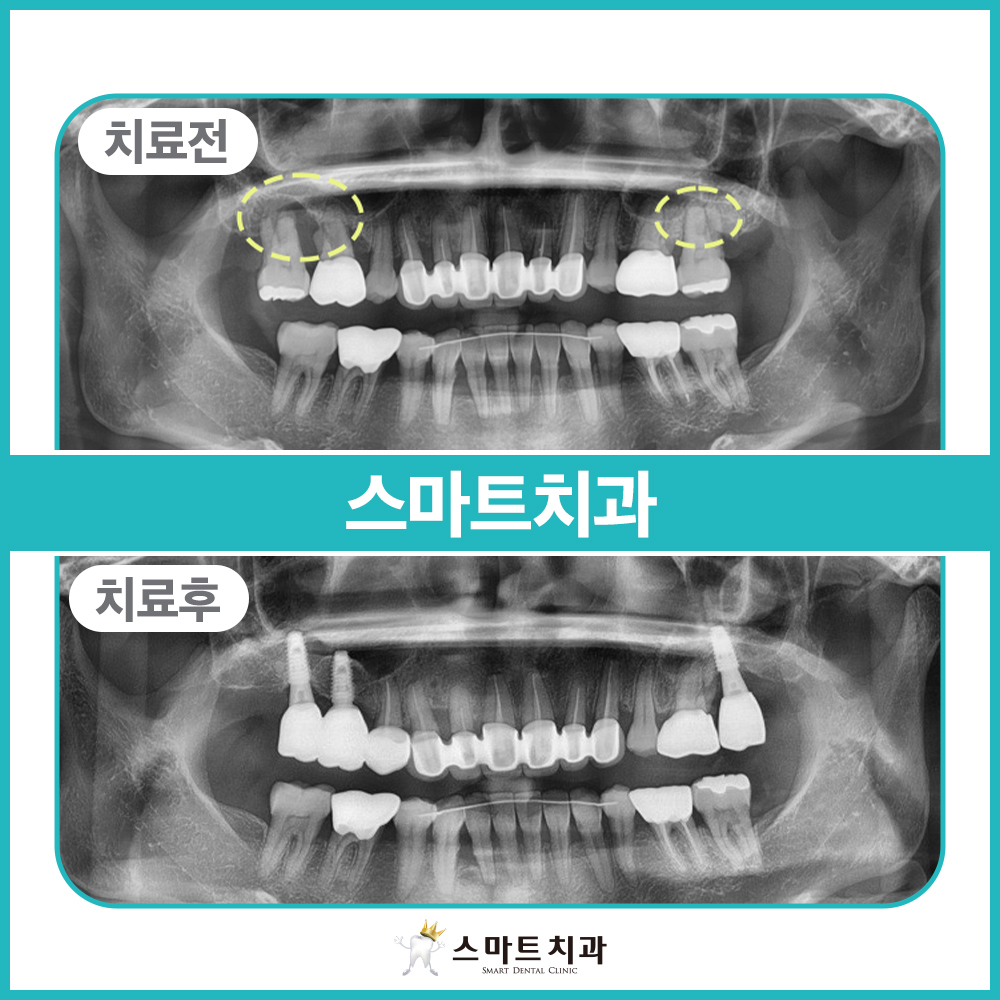 안락동임플란트