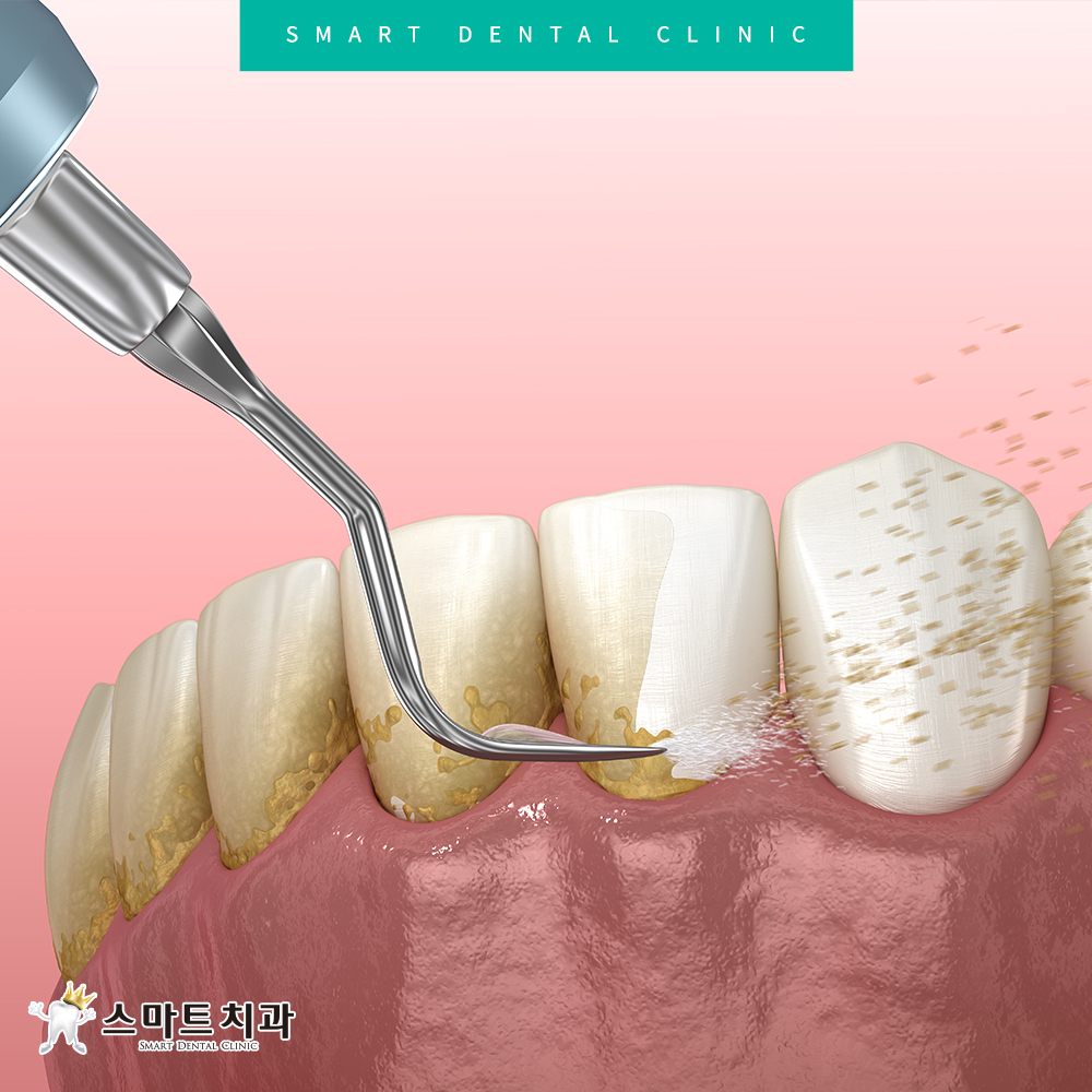 서동스케일링치과